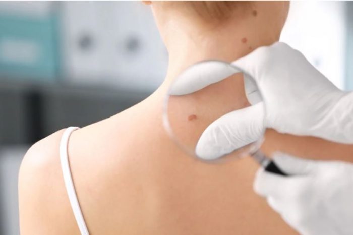 En Argentina se diagnostican por año cerca de 130 mil casos de melanoma