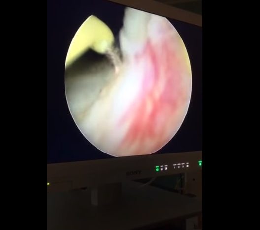 Se realizó en el Hospital Ramón Carrillo la primera cirugía de próstata con instrumental entregado por Salud de Neuquén