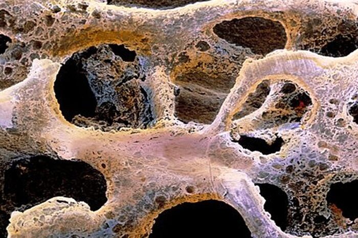 La pandemia incrementó la fragilidad en personas con osteoporosis