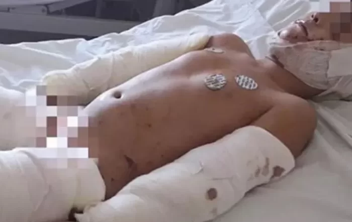 Un nene fue atacado por cuatro perros y tuvieron que darle 110 puntos de sutura: “Se lo quisieron comer”