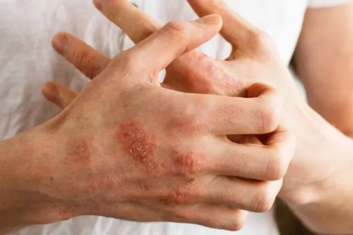 El primer tratamiento para la psoriasis pustulosa generalizada ya está disponible en Argentina