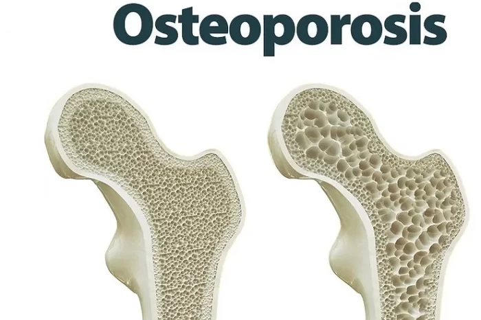 Osteoporosis y Nutrición